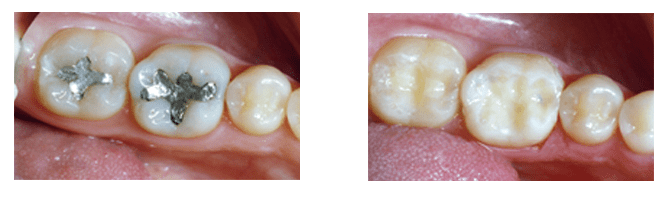 Tooth-colored fillings are a discrete way to restore cavities